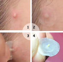 Load image into Gallery viewer, Skin Tag &amp; Acne Patch 24 PCS
